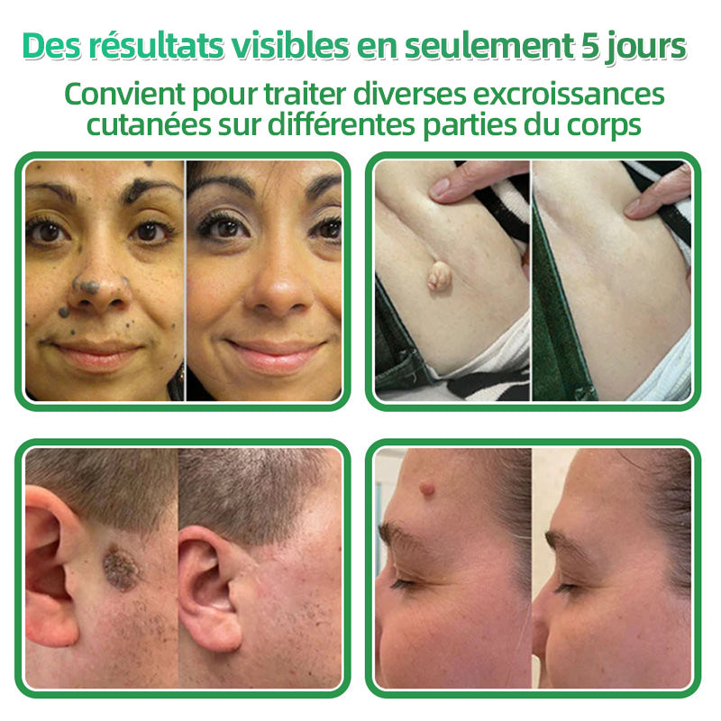 ✅ Patchs hydrocolloïdes à micro-aiguilles 2 en 1 𝐇𝐮𝐝𝐫𝐨s® | Élimine les grains de beauté en relief, l'acné, les verrues planes et les acrochordons | Patchs invisibles pour le visage et le corps | 144 patchs