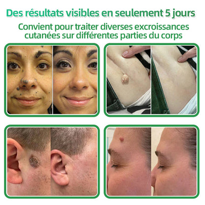 ✅ Patchs hydrocolloïdes à micro-aiguilles 2 en 1 𝐇𝐮𝐝𝐫𝐨s® | Élimine les grains de beauté en relief, l'acné, les verrues planes et les acrochordons | Patchs invisibles pour le visage et le corps | 144 patchs