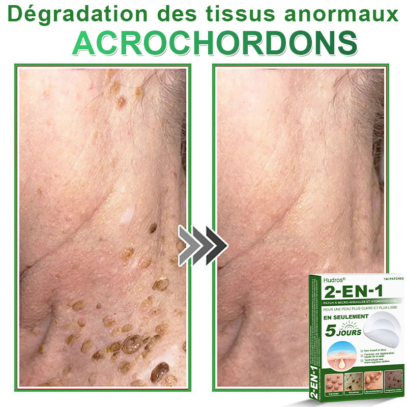 ✅ Patchs hydrocolloïdes à micro-aiguilles 2 en 1 𝐇𝐮𝐝𝐫𝐨s® | Élimine les grains de beauté en relief, l'acné, les verrues planes et les acrochordons | Patchs invisibles pour le visage et le corps | 144 patchs