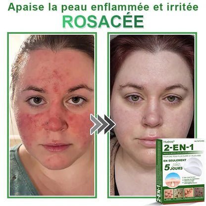 ✅ Patchs hydrocolloïdes à micro-aiguilles 2 en 1 𝐇𝐮𝐝𝐫𝐨s® | Élimine les grains de beauté en relief, l'acné, les verrues planes et les acrochordons | Patchs invisibles pour le visage et le corps | 144 patchs