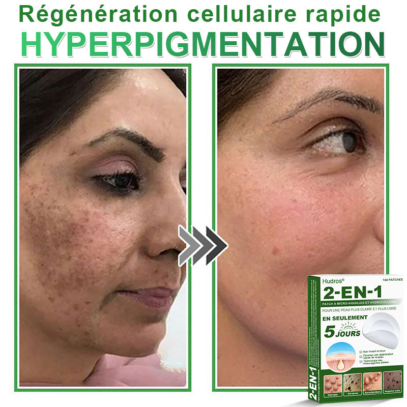 ✅ Patchs hydrocolloïdes à micro-aiguilles 2 en 1 𝐇𝐮𝐝𝐫𝐨s® | Élimine les grains de beauté en relief, l'acné, les verrues planes et les acrochordons | Patchs invisibles pour le visage et le corps | 144 patchs