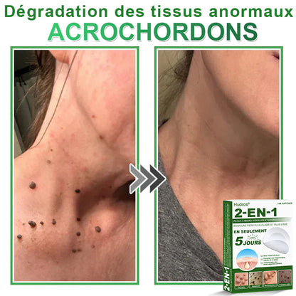✅ Patchs hydrocolloïdes à micro-aiguilles 2 en 1 𝐇𝐮𝐝𝐫𝐨s® | Élimine les grains de beauté en relief, l'acné, les verrues planes et les acrochordons | Patchs invisibles pour le visage et le corps | 144 patchs