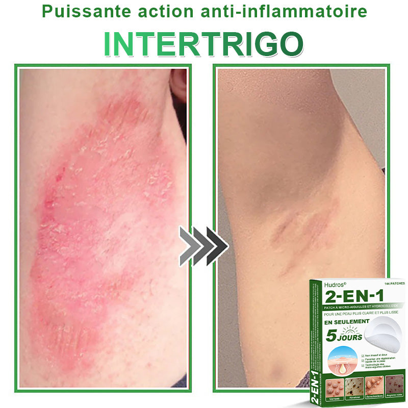 ✅ Patchs hydrocolloïdes à micro-aiguilles 2 en 1 𝐇𝐮𝐝𝐫𝐨s® | Élimine les grains de beauté en relief, l'acné, les verrues planes et les acrochordons | Patchs invisibles pour le visage et le corps | 144 patchs